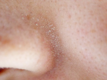 鼻やひたいなど皮脂の多いTゾーンを中心によく見られる、角栓の詰まった毛穴.jpg