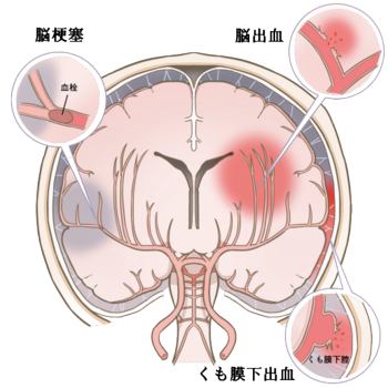 stroke-subarachnoid-hemorrhage-cerebral-hemorrhage-cerebral-infarction.png