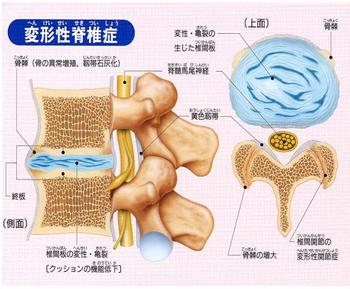 変形性脊椎症