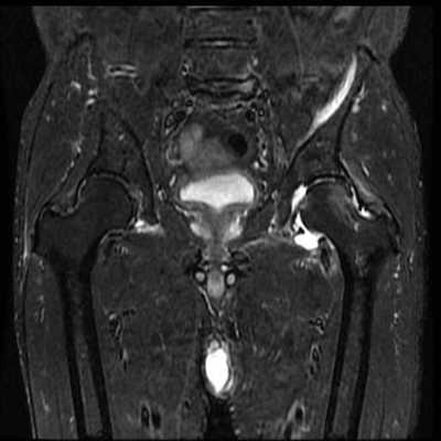 股関節ＭＲＩ　ＳＴＩＲ