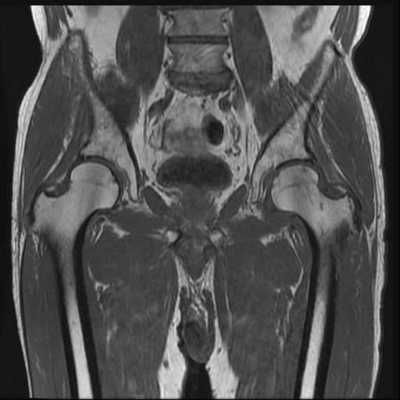 股関節ＭＲＩ　Ｔ１