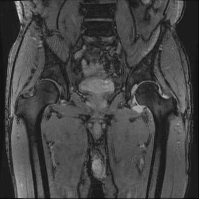 股関節ＭＲＩ　Ｔ２スター