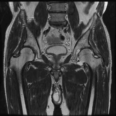 股関節　ＭＲＩ