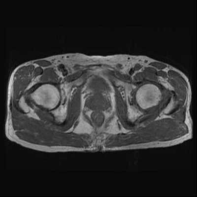 股関節ＭＲＩ　ＡＸＩ